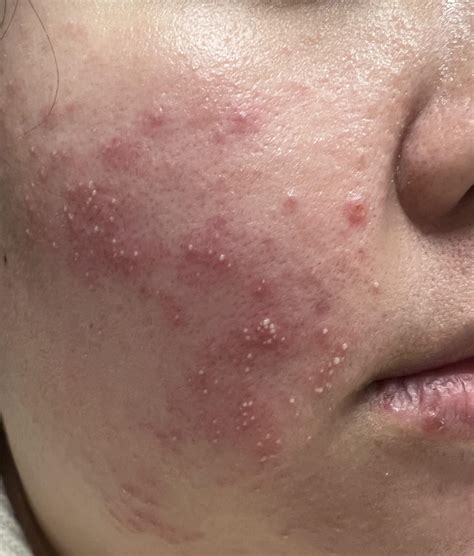 Skin irritation? Any ideas what this is? : r/skin