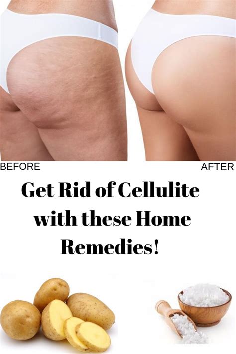 how to get rid of cellulite at home