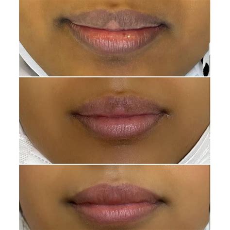 laser lip lightening effects cost risks