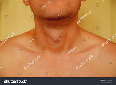 Allergic Skin Rash Spots On Neck Stock Photo 682209592 | Shutterstock