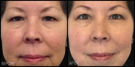 Ultherapy Before And After Eyes