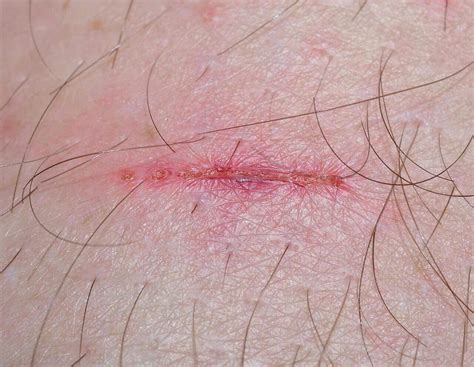 How to Tell if a Wound is Healing or Infected? Amazing Facts!