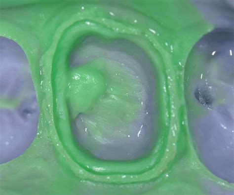 Triple Tray Versus Full Arch Impressions - Lee Ann Brady, DMD's Dental Blog
