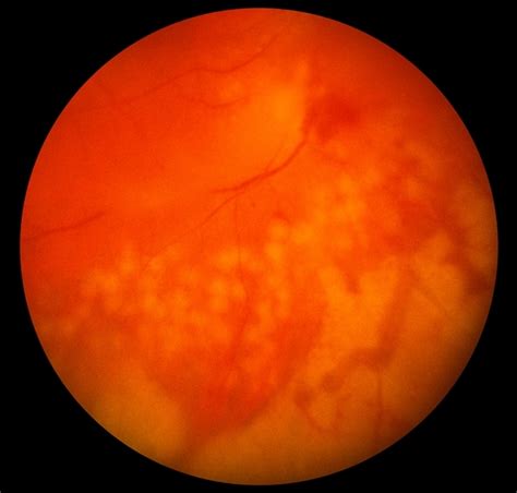 Acute Retinal Necrosis - Retina Image Bank