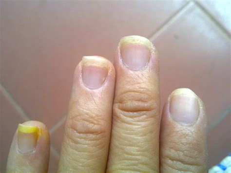 How To Get Rid Of White Spots Under Fingernails at Hudson Hawker blog