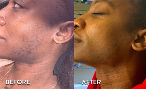 Laser Hair Removal Before And After