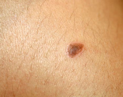 burn   skin blister   skin stock photo  image