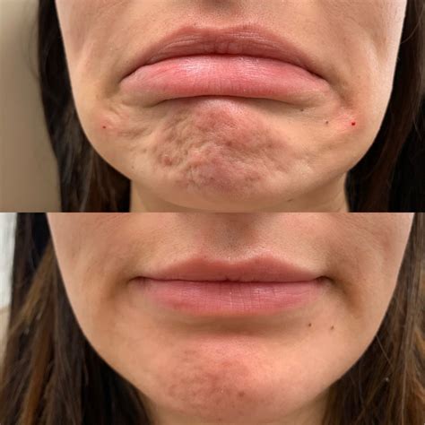 Botox Before and After - Beauty Boost Med Spa