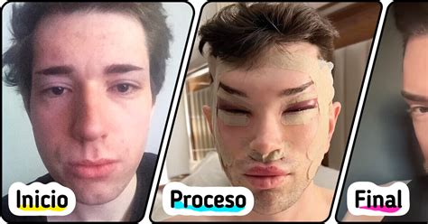La radical transformación de un hombre tras cirugías en el rostro, para