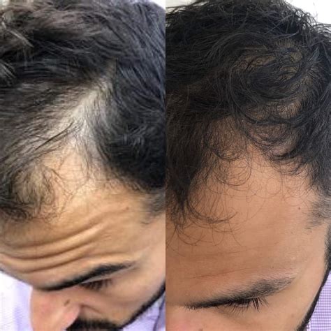 Hair Restoration Before – Hair Removal Before And After – WEOS
