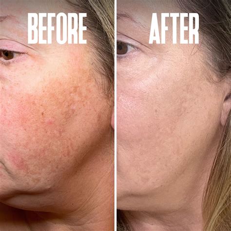 Hydroquinone Cream Before And After