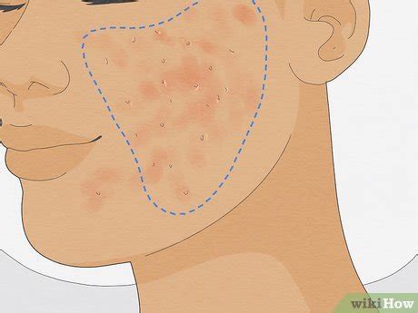 4 Ways to Get Rid of Cystic Acne Scars - wikiHow