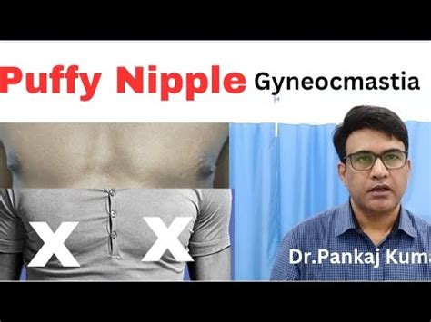 Puffy nipples treatment| Grade 1 Gynecomastia treatment| Gynecomastia