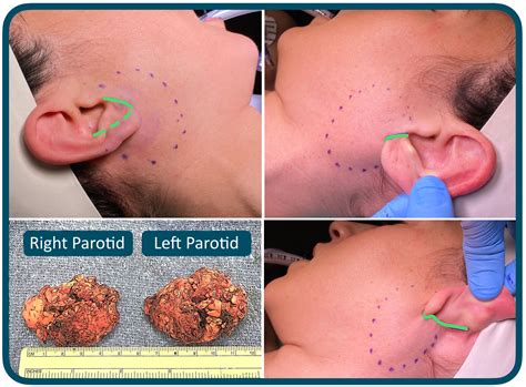 Swollen Parotid Gland