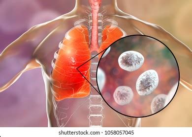 195 Fungal pneumonia Images, Stock Photos & Vectors | Shutterstock