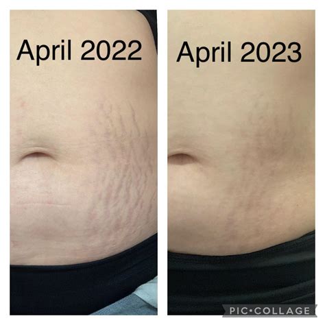 [Before and After] 1 year of Stretch Mark Treatment with Glycolic Acid