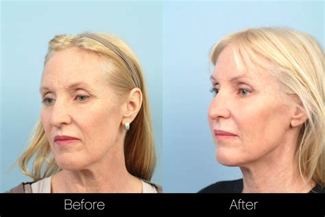 Thread Lift Procedure in Toronto | SpaMedica
