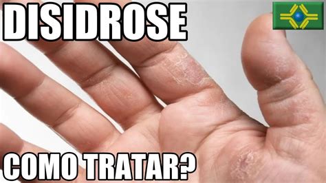 Como Tratar A Disidrose - DISIDROSE | DISIDROSE PALMO PLANTAR | O que fazer? | Como Tratar ...