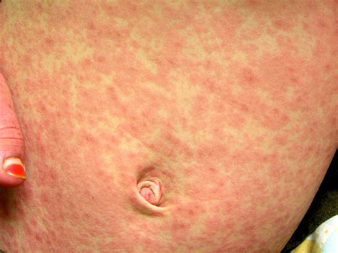 Roseola vs Measles: What’s the Difference?