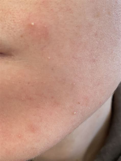 Gram Negative Folliculitis? – Acne – Acne.org Forum