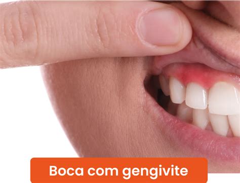 Tenho Gengivite E Beijei Um Soropositivo