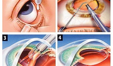 Como É A Cirurgia De Catarata - Catarata: O que é? | causas | sintomas | cirurgia | resultado ...