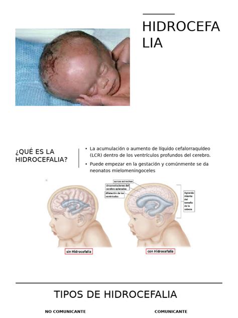 Hidrocefalia De Pressao Normal - Tipos y Tratamiento de Hidrocefalia | PDF | Fluido cerebroespinal ...