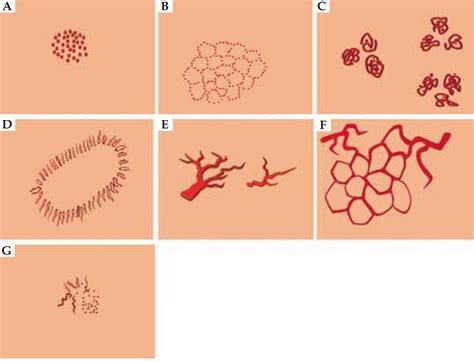 scielo brasil vascular structures  dermoscopy vascular structures