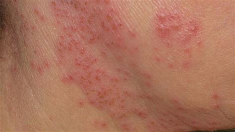 Eczema Blisters: Types, Causes, and Treatments