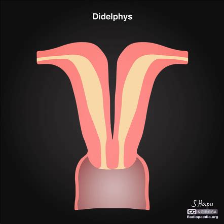 Didelphys Uterus – Uterus Delphinus – IXXLIQ