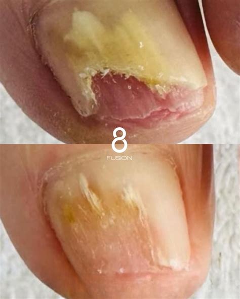 Plasma - Dealing with nail fungus or damaged toenails? 🦶 Fusion 8 is