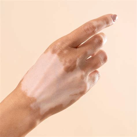 Vitiligo pigmentation cream - Uncover