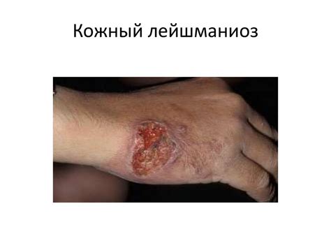Виды лейшманиозов - online presentation