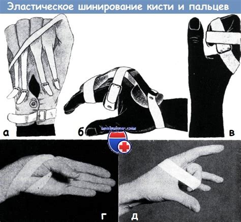Насильственная пассивная мобилизация кисти и пальцев эластическими шинами