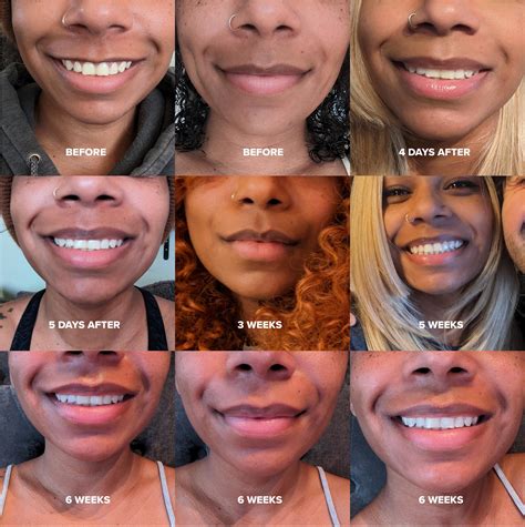 Lip Flip before and afters : r/Splendida