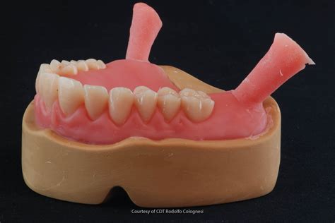 Analogue vs digital workflow for removable full dentures