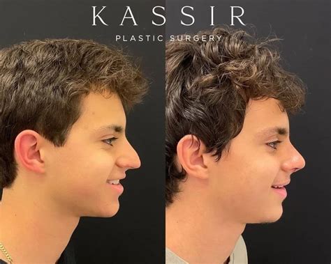 male celebrity nose job