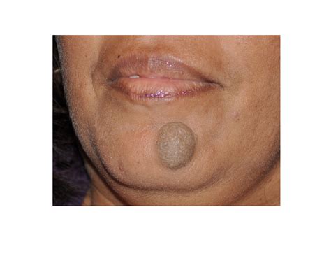 Mole On Face