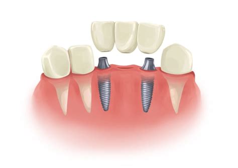 types  dental bridges   westerville