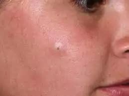 kista epidermis epidermal cysts penyebab gejala penanganan