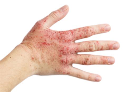 understanding hand  wrist dermatitis symptoms