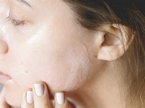 Red Skin Syndrome: Stages, Treatment, Healing, and More