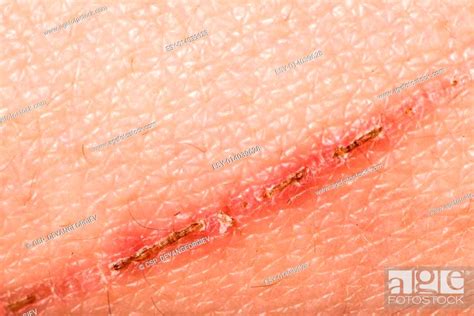 Texture of human skin and scratch, Stock Photo, Picture And Low Budget ...