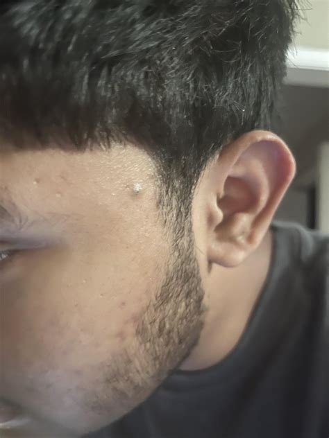 Very Large Blackhead Removal By Dermatologist How To Remove Very Deep