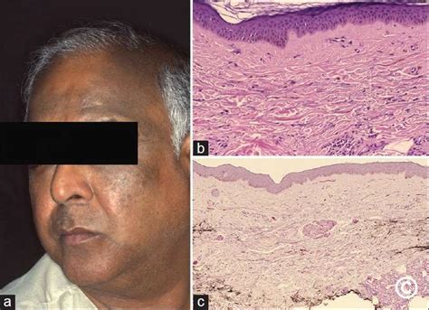 hyperpigmentation   face  neck