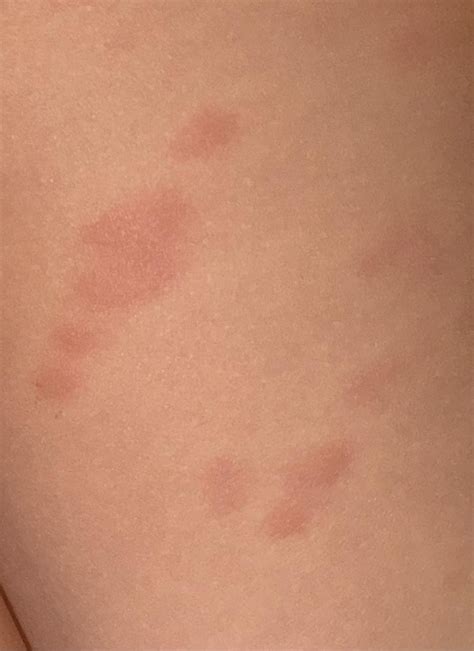 Does this look like scabies? : r/scabies