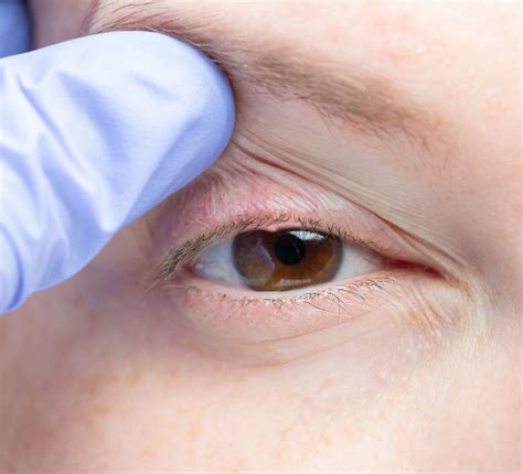 Causes Of Eyelid Bumps _ Eyelid Bump Symptoms – QUQK