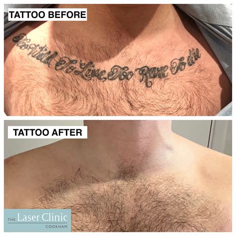 tattoo removal results 2