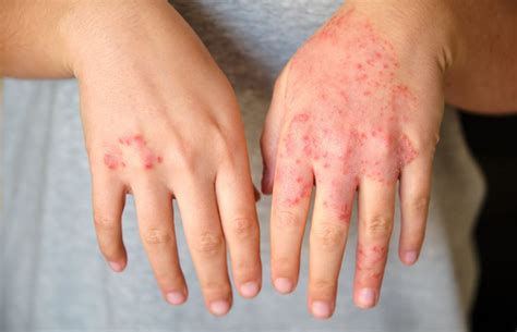 Coceiras Nas Mãos O Que Pode Ser - Coceira nas mãos, o que pode ser? - Dermatologista Ana Luiza Villarinho ...