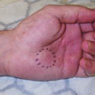 localized area  swelling   level   hypothenar eminence